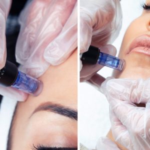 Nanoneedling vs. Microneedling: Which Skin Treatment is Right for You?